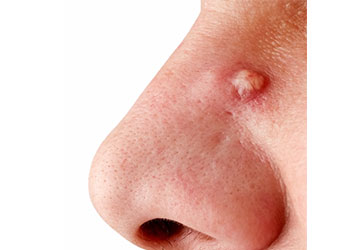 鼻 の 横 ニキビ 原因